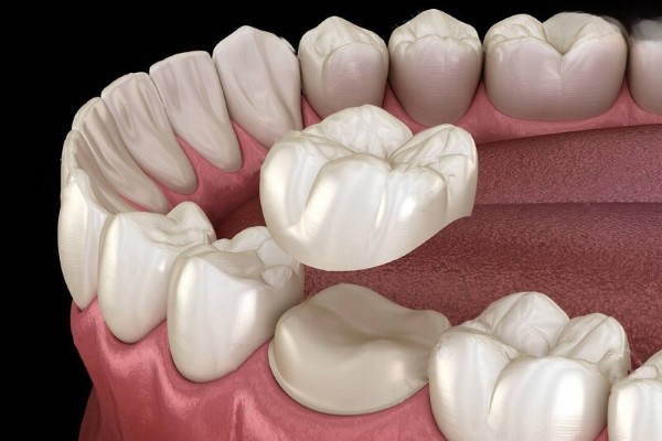 Bọc răng sứ cho răng sâu sau khi trám hoặc lấy tủy