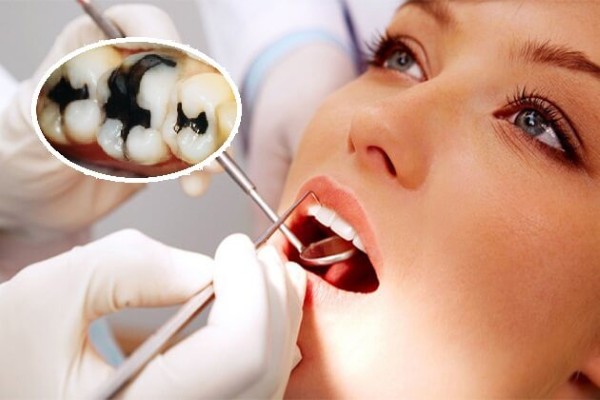 Việc điều trị răng sâu nặng sớm mang lại nhiều lợi ích cho sức khỏe