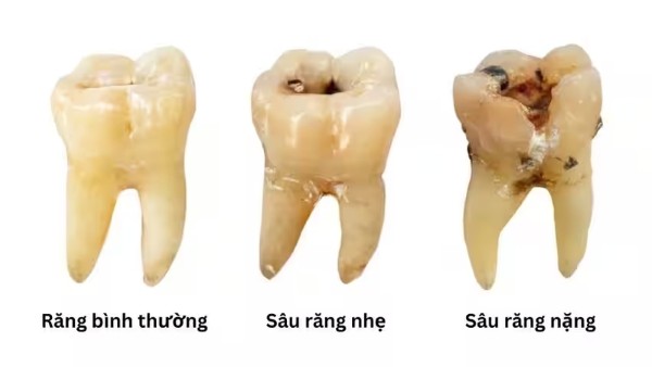 Răng sâu là gì? Răng sâu tự lành được không?