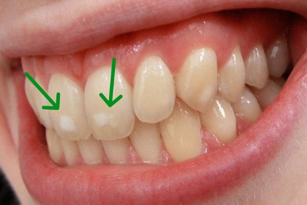 Men răng xuất hiện các đốm trắng hoặc nâu