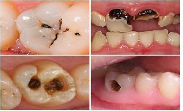 Các cấp độ sâu răng từ nhẹ đến nặng