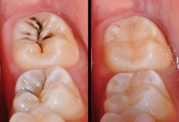 Răng sâu tự lành được không?