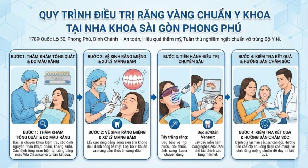 Quy trình điều trị răng vàng chuẩn Y khoa tại Nha khoa Sài Gòn Phong Phú Quy trình điều trị răng vàng chuẩn Y khoa tại Nha khoa Sài Gòn Phong Phú