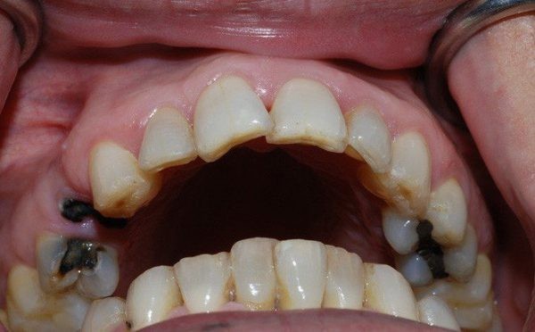 Các nguyên nhân dẫn đến tình trạng sâu răng đen