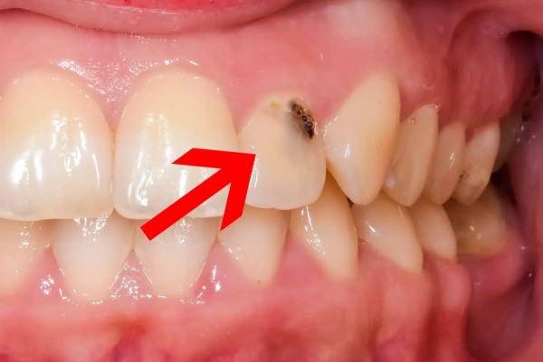 Xuất hiện đốm đen là dấu hiệu đầu tiên của sâu răng đen
