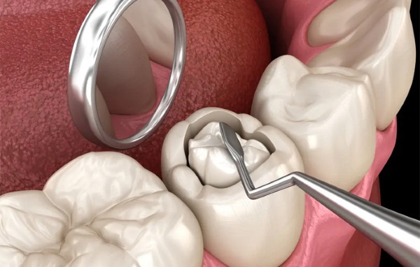 Trám răng – Giải pháp cho sâu răng đen ở giai đoạn nhẹ