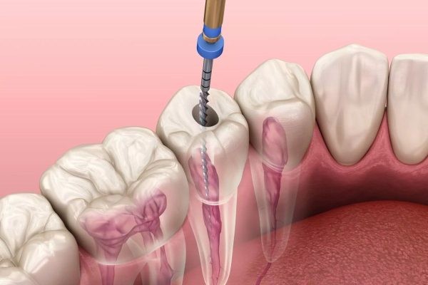 Lấy tủy răng là biện pháp điều trị sâu răng đen khi tiến triển nặng