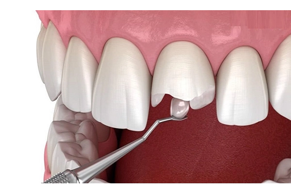 Phương pháp trám răng cửa bị sâu phổ biến hiện nay