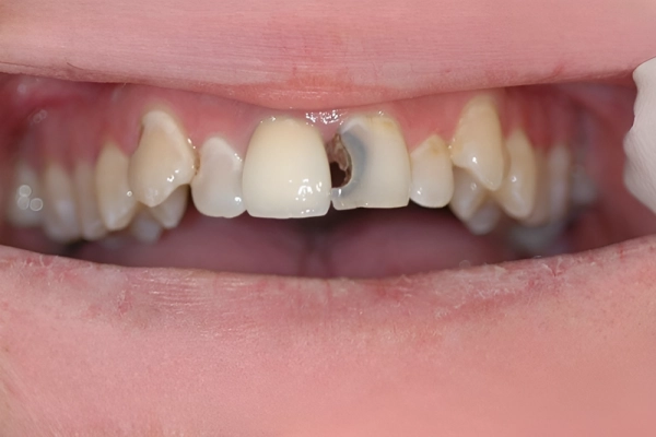 Trám răng cửa bị sâu giá bao nhiêu?