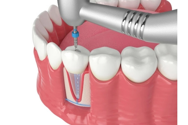 Trám răng sâu có cần lấy tủy không?