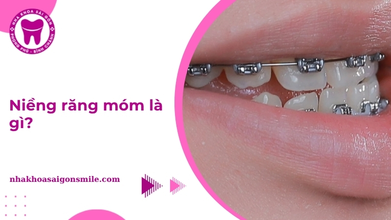 212. Nieng rang mom la gi Quy trinh chi phi va hieu qua chinh nha