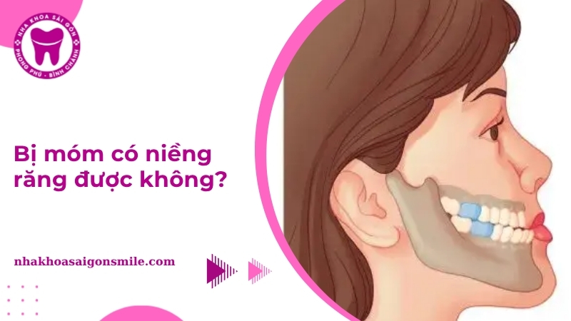 213. Bi mom co nieng rang duoc khong Giai dap tu bac si nha khoa