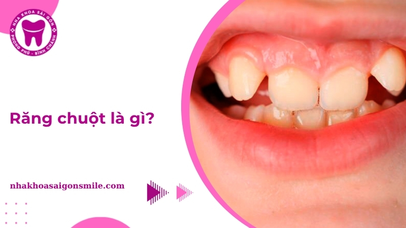 Răng chuột là gì? Dấu hiệu, nguyên nhân và cách khắc phục
