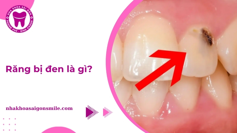 Răng bị đen là gì? Nguyên nhân và cách khắc phục hiệu quả