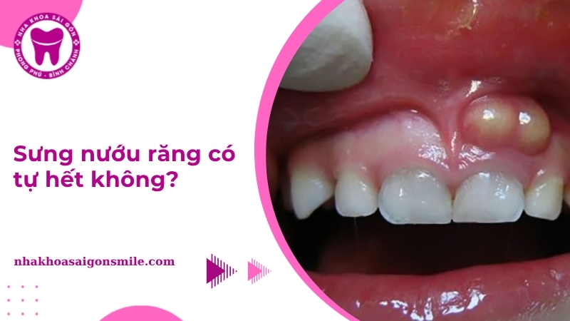 Sưng nướu răng có tự hết không? Giải đáp từ bác sĩ nha khoa