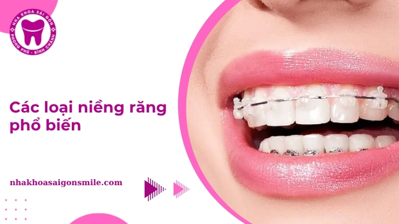Các loại niềng răng phổ biến và ưu nhược điểm bạn nên biết