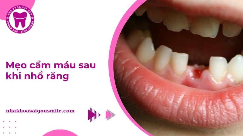 Mẹo cầm máu sau khi nhổ răng an toàn và hiệu quả