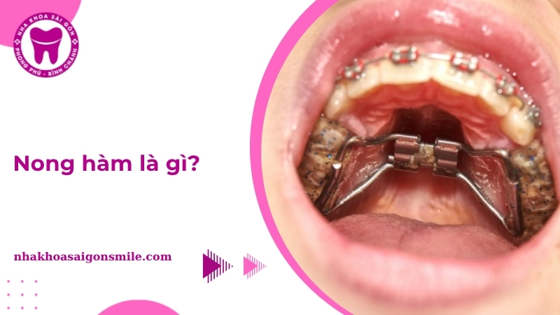 240. Nong ham la gi Truong hop phuong phap chi phi va thoi gian