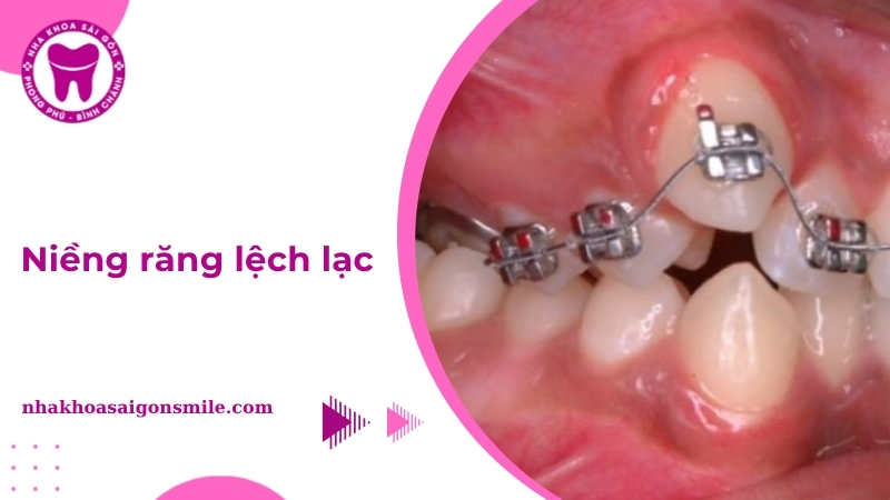 241. Nieng rang lech lac Nguyen nhan phuong phap va chi phi