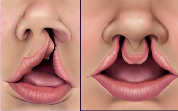 Hở hàm ếch là một dạng dị tật bẩm sinh