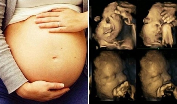 Các nguyên nhân gây ra bệnh hở hàm ếch