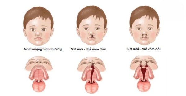 Dấu hiệu nhận biết hở hàm ếch ở trẻ sơ sinh