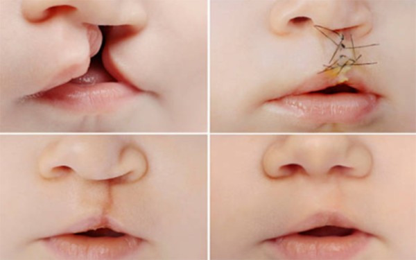 Các biện pháp điều trị bệnh hở hàm ếch