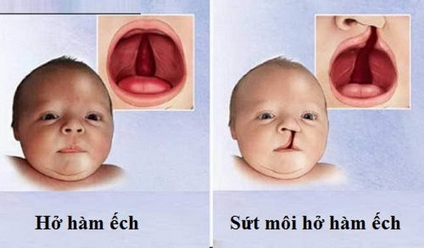 Một số câu hỏi thường gặp về hở hàm ếch