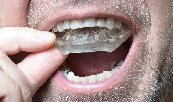 Nghiến răng khi ngủ là gì? Nguyên nhân và cách khắc phục 9 Đeo máng chống nghiến hay chỉnh sửa cấu trúc răng