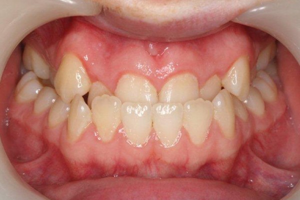 Niềng răng không mắc cài là gì? Ưu nhược điểm & quy trình chi tiết 14 Răng lệch nặng, khớp cắn sâu, khớp cắn chéo cần cân nhắc khi lựa chọn niềng răng