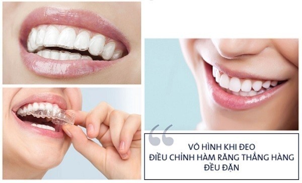 Niềng răng không mắc cài là gì? Ưu nhược điểm & quy trình chi tiết 18 Ưu điểm của niềng răng không mắc cài