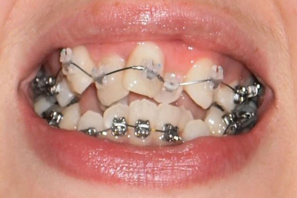 Niềng răng lệch lạc là phương pháp chỉnh nha sắp xếp lại những răng mọc sai vị trí