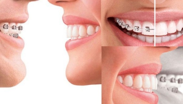 Niềng răng lệch lạc mang lại nhiều lợi ích quan trọng cho sức khỏe răng miệng