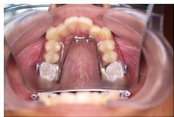 Các câu hỏi thường gặp về nong hàm