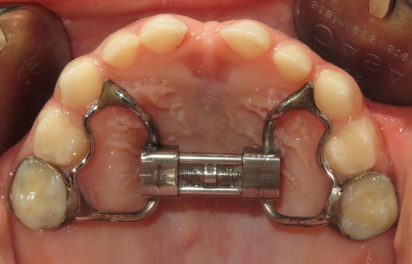 Nong hàm chậm / RPE (Rapid Palatal Expander)