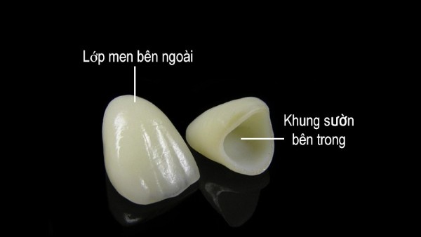 Răng sứ Venus là gì? Ưu nhược điểm và cách chăm sóc 2 Cấu tạo của răng sứ Venus