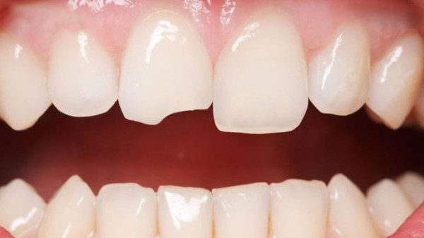 Răng sứ Venus là gì? Ưu nhược điểm và cách chăm sóc 3 Trường hợp răng bị mẻ vỡ