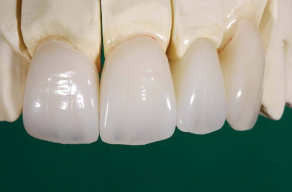 Răng sứ Venus là gì? Ưu nhược điểm và cách chăm sóc 7 Ưu và nhược điểm của răng sứ Venus