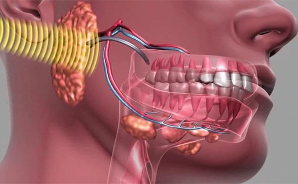 Xương hàm dưới là gì? Giải phẫu, cấu tạo và chức năng quan trọng 21 Ung thư xương hàm dưới phát triển từ các phần xung quanh