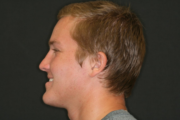 Các câu hỏi thường gặp về vấn đề "bị móm có niềng răng được không?"