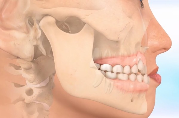 Móm do xương hàm