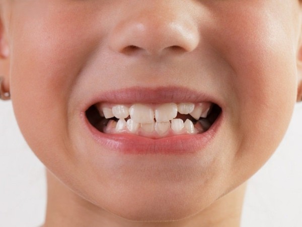 Khi cắn ngược hàm và thấy hàm dưới nhô ra rõ rệt