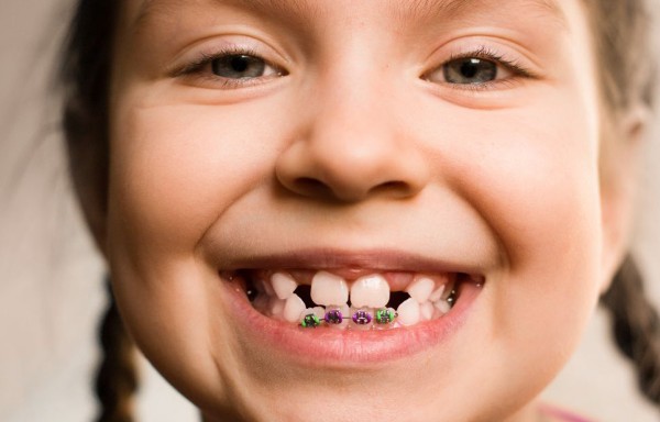 Niềng răng cho trẻ em bị móm giúp trẻ phát triển đúng cấu trúc hàm mặt