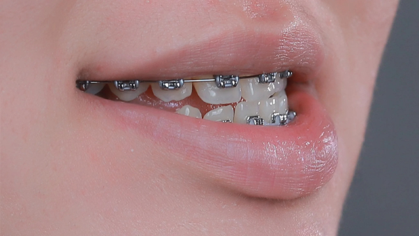 Niềng răng cho người lớn chỉnh sửa khuyết điểm về răng miệng