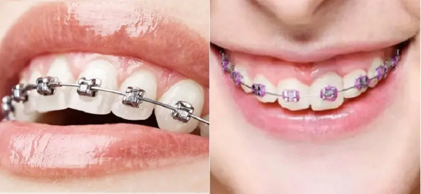 Niềng răng mắc cài kim loại