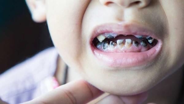 Có nên nhổ răng sữa khi chưa lung lay? Lời khuyên từ nha sĩ 3 Các trường hợp nên nhổ răng sữa khi chưa lung lay