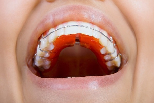 Hàm duy trì Hawley hoạt động như thế nào? Hàm duy trì Hawley hoạt động như thế nào?