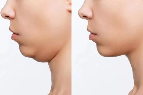 Jawline có tác dụng gì? Jawline có tác dụng gì?