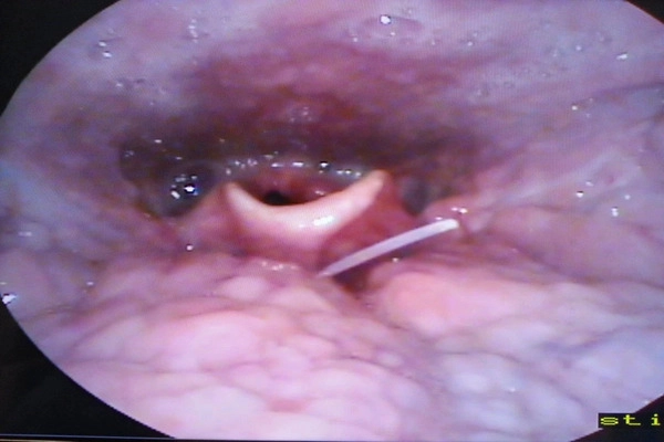 Hóc xương cá nguy hiểm như thế nào? Hóc xương cá nguy hiểm như thế nào?