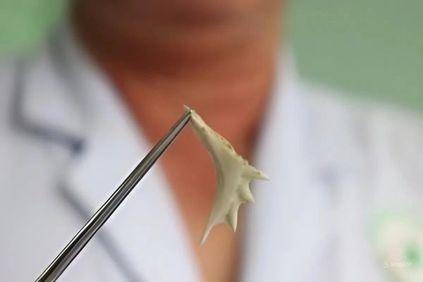 Liệu mẹo chữa hóc xương cá bằng đũa có hiệu quả? Liệu mẹo chữa hóc xương cá bằng đũa có hiệu quả?